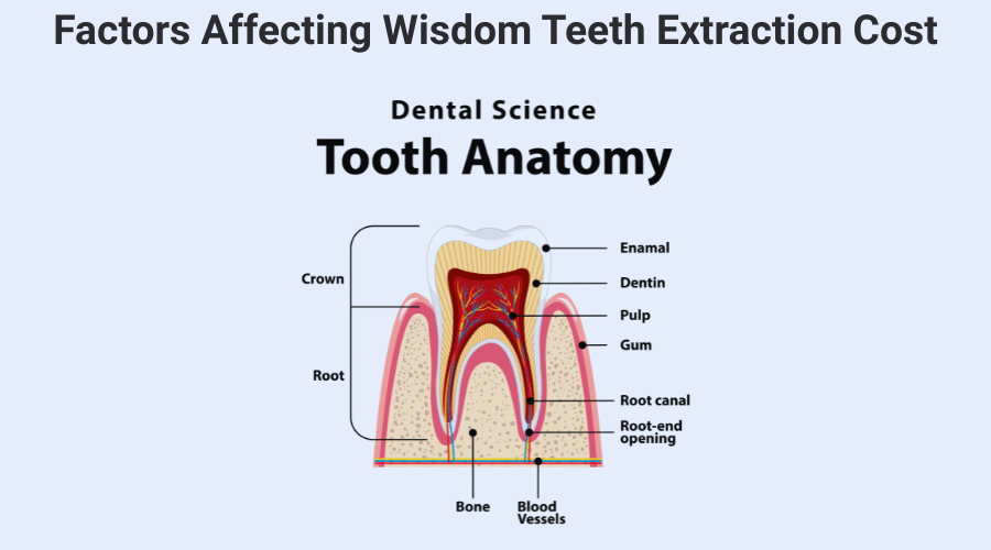 Diagram showing factors affecting wisdom tooth extraction cost